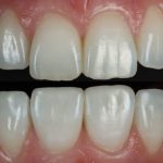 Creating Natural Smiles: The Evolution of Composite Bonding