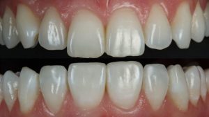 Creating Natural Smiles: The Evolution of Composite Bonding