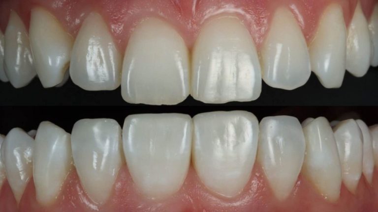Creating Natural Smiles: The Evolution of Composite Bonding