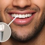 Why Dental Implants Offer Superior Stability Compared to Removable Prosthetics