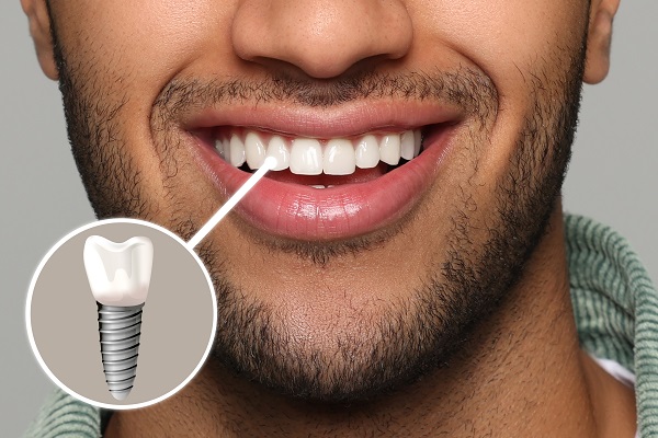 Why Dental Implants Offer Superior Stability Compared to Removable Prosthetics